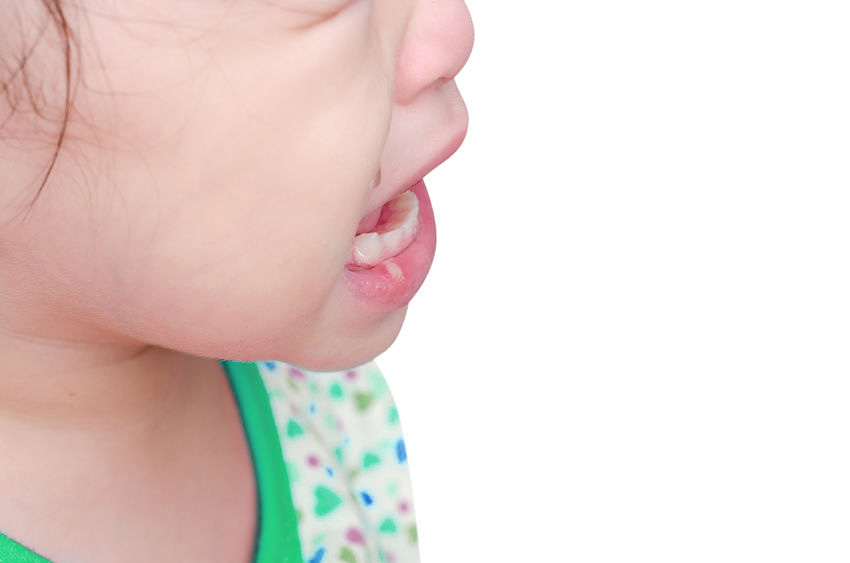 Inilah Cara Ampuh Mengatasi Sariawan pada Anak What is Aphthous Stomatitis in Children and How to Handle It